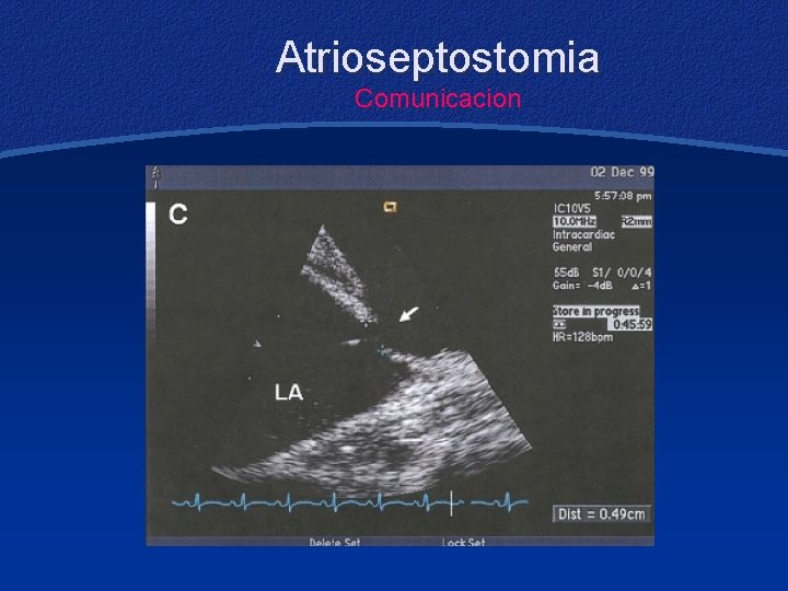 Atrioseptostomia Comunicacion 