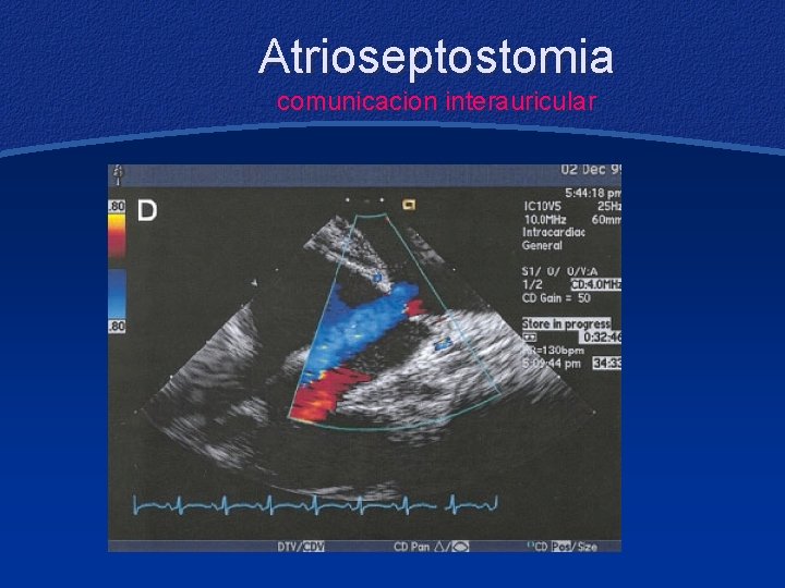 Atrioseptostomia comunicacion interauricular 