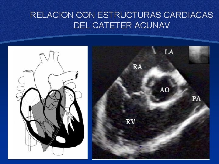 RELACION CON ESTRUCTURAS CARDIACAS DEL CATETER ACUNAV 