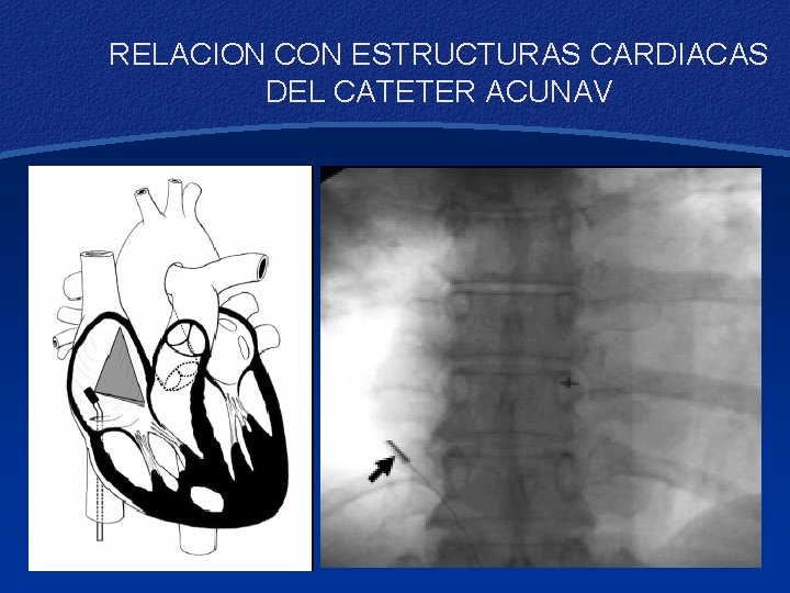 RELACION CON ESTRUCTURAS CARDIACAS DEL CATETER ACUNAV 