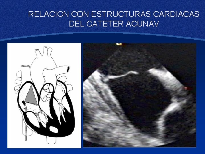 RELACION CON ESTRUCTURAS CARDIACAS DEL CATETER ACUNAV 