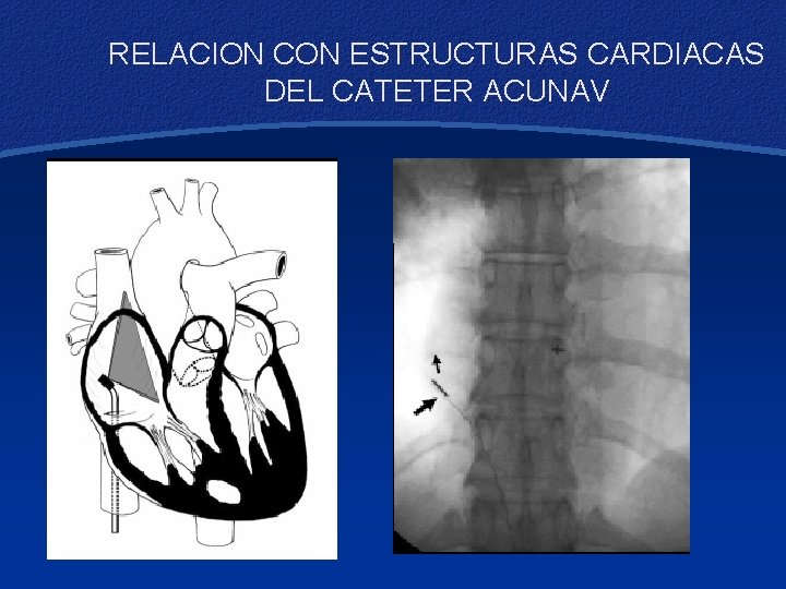 RELACION CON ESTRUCTURAS CARDIACAS DEL CATETER ACUNAV 