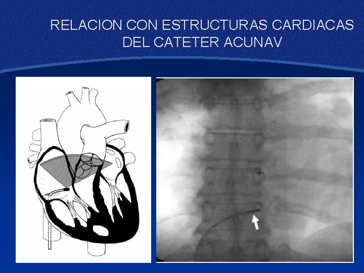 RELACION CON ESTRUCTURAS CARDIACAS DEL CATETER ACUNAV 