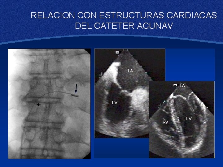 RELACION CON ESTRUCTURAS CARDIACAS DEL CATETER ACUNAV 