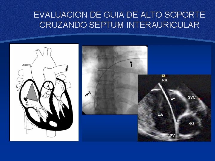 EVALUACION DE GUIA DE ALTO SOPORTE CRUZANDO SEPTUM INTERAURICULAR 