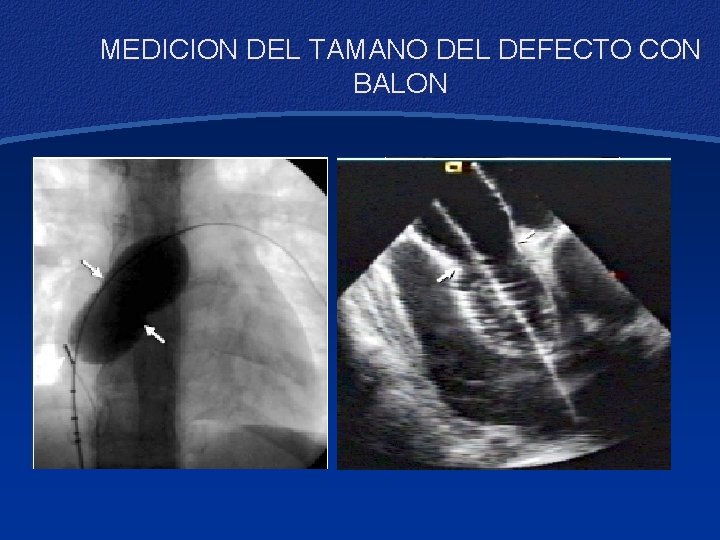 MEDICION DEL TAMANO DEL DEFECTO CON BALON 