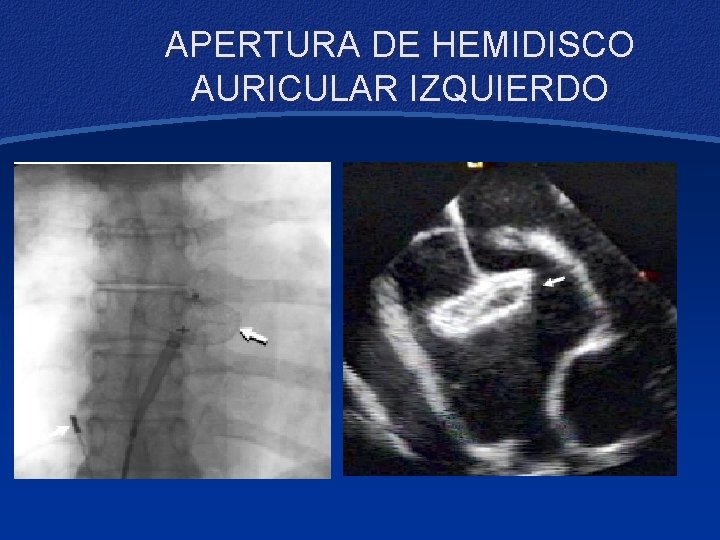 APERTURA DE HEMIDISCO AURICULAR IZQUIERDO 