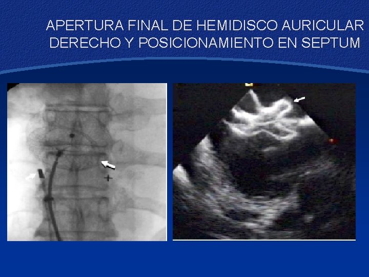 APERTURA FINAL DE HEMIDISCO AURICULAR DERECHO Y POSICIONAMIENTO EN SEPTUM 