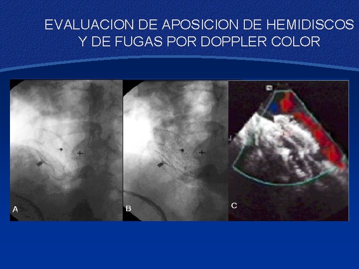 EVALUACION DE APOSICION DE HEMIDISCOS Y DE FUGAS POR DOPPLER COLOR 