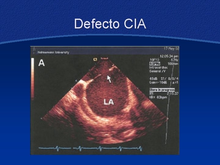 Defecto CIA 