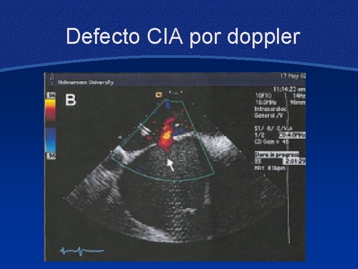 Defecto CIA por doppler 