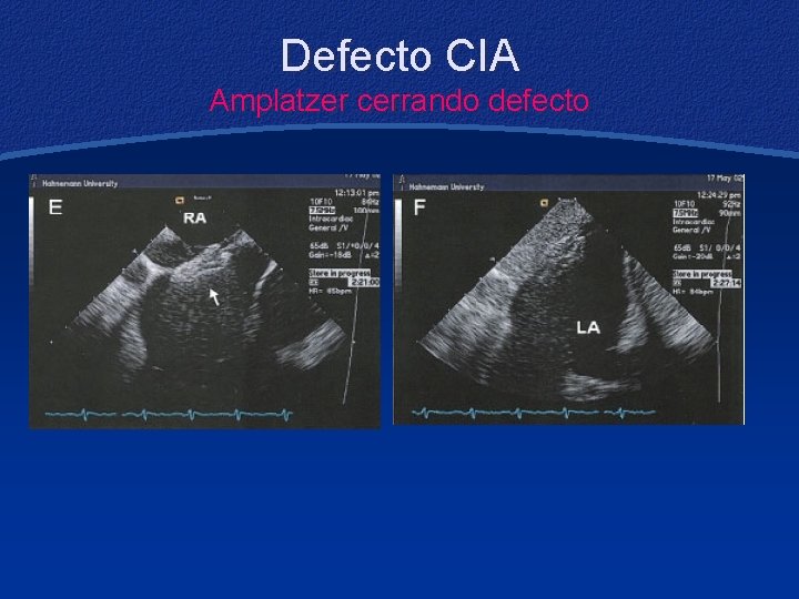 Defecto CIA Amplatzer cerrando defecto 