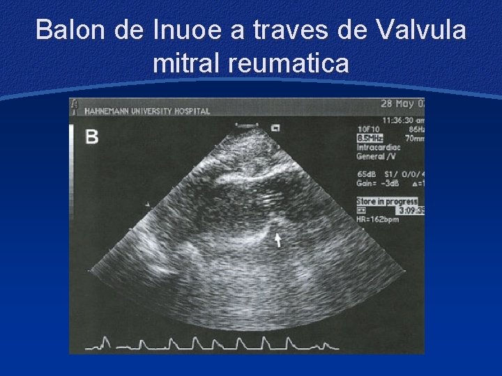 Balon de Inuoe a traves de Valvula mitral reumatica 