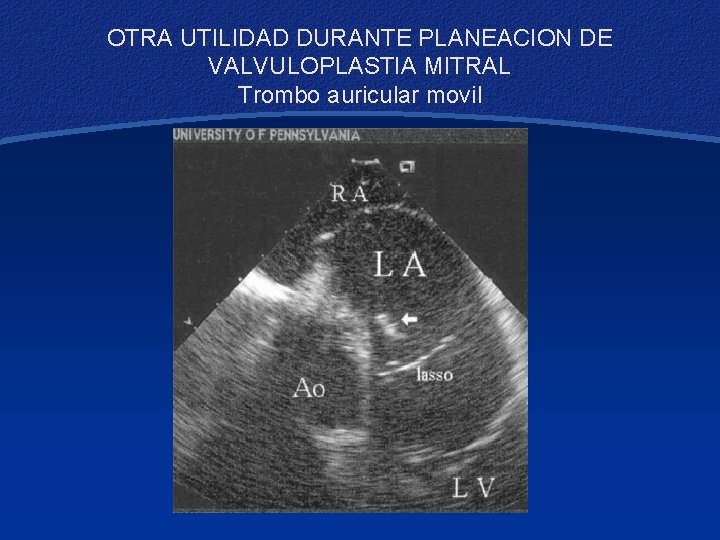 OTRA UTILIDAD DURANTE PLANEACION DE VALVULOPLASTIA MITRAL Trombo auricular movil 