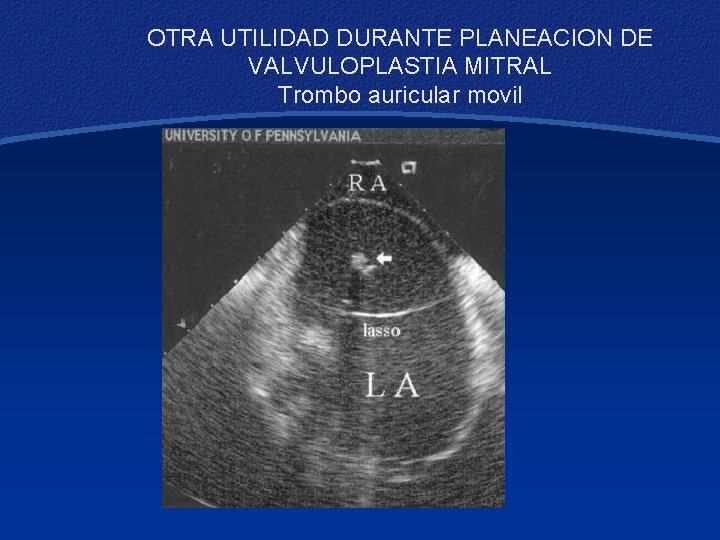 OTRA UTILIDAD DURANTE PLANEACION DE VALVULOPLASTIA MITRAL Trombo auricular movil 