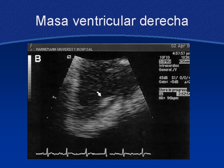 Masa ventricular derecha 