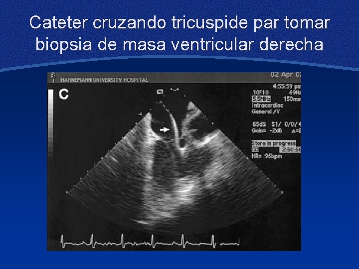 Cateter cruzando tricuspide par tomar biopsia de masa ventricular derecha 