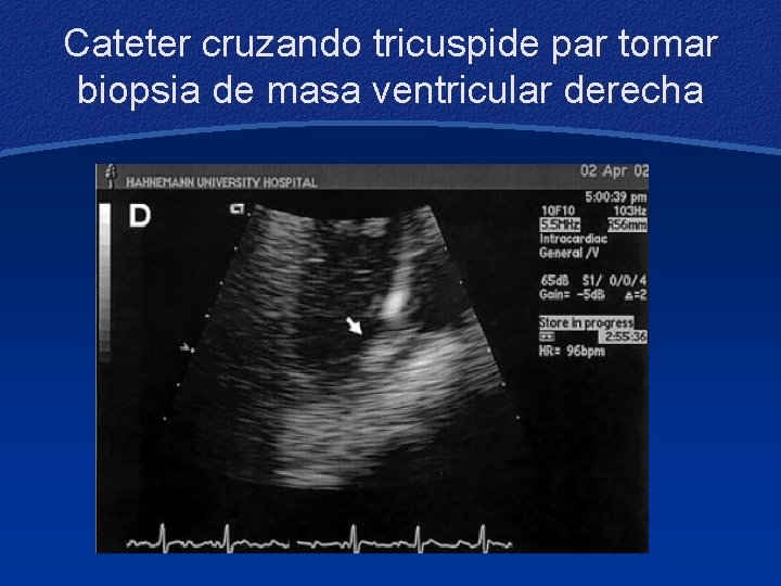 Cateter cruzando tricuspide par tomar biopsia de masa ventricular derecha 