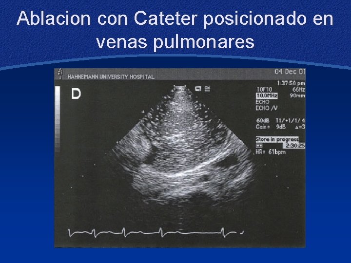 Ablacion con Cateter posicionado en venas pulmonares 