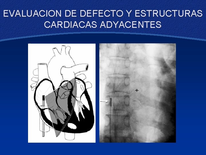 EVALUACION DE DEFECTO Y ESTRUCTURAS CARDIACAS ADYACENTES 