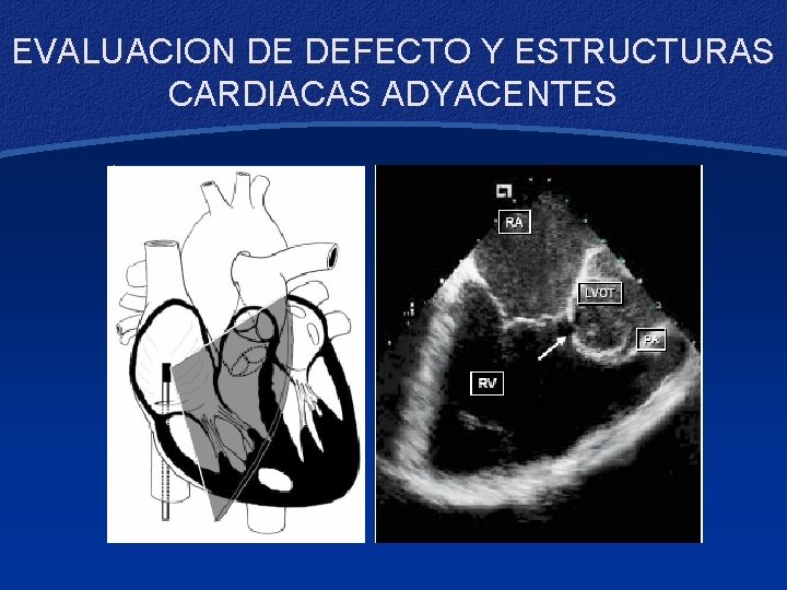 EVALUACION DE DEFECTO Y ESTRUCTURAS CARDIACAS ADYACENTES 