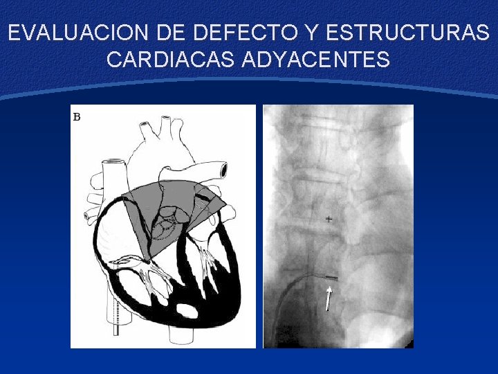 EVALUACION DE DEFECTO Y ESTRUCTURAS CARDIACAS ADYACENTES 