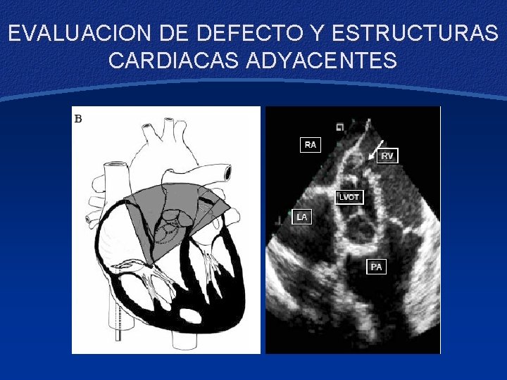 EVALUACION DE DEFECTO Y ESTRUCTURAS CARDIACAS ADYACENTES 