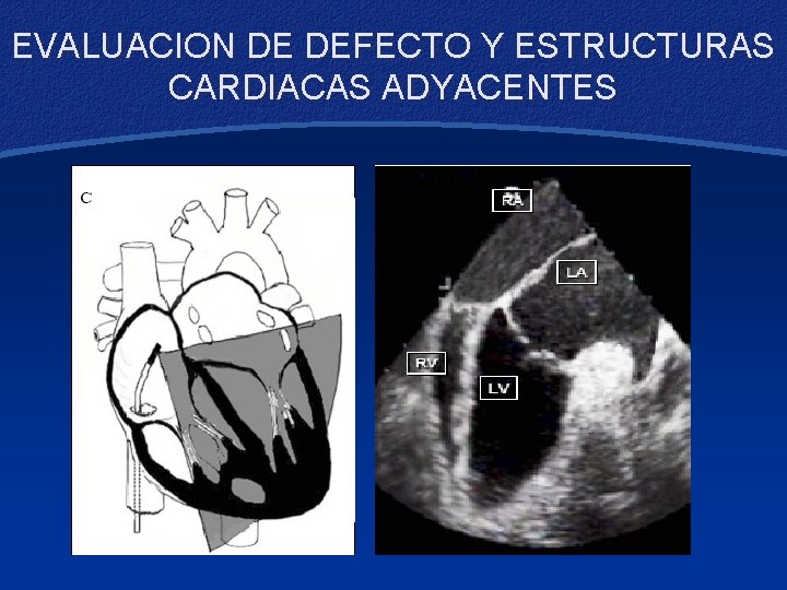 EVALUACION DE DEFECTO Y ESTRUCTURAS CARDIACAS ADYACENTES 