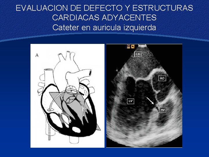 EVALUACION DE DEFECTO Y ESTRUCTURAS CARDIACAS ADYACENTES Cateter en auricula izquierda 