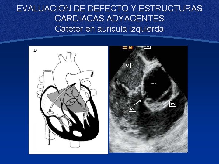 EVALUACION DE DEFECTO Y ESTRUCTURAS CARDIACAS ADYACENTES Cateter en auricula izquierda 