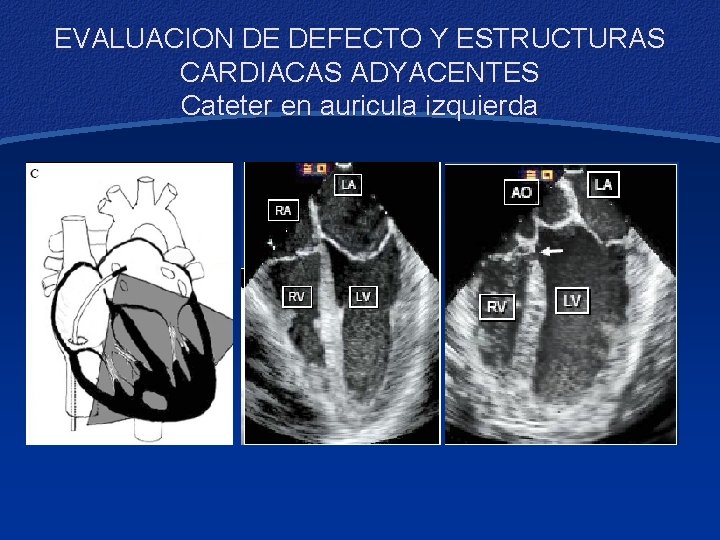 EVALUACION DE DEFECTO Y ESTRUCTURAS CARDIACAS ADYACENTES Cateter en auricula izquierda 