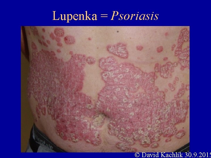 Lupenka = Psoriasis © David Kachlík 30. 9. 2015 