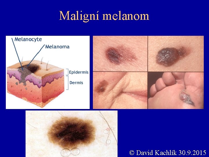 Maligní melanom © David Kachlík 30. 9. 2015 