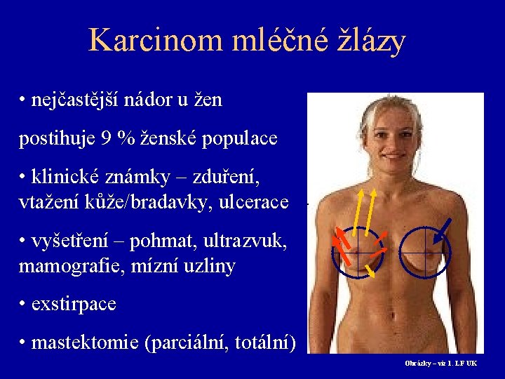 Karcinom mléčné žlázy • nejčastější nádor u žen postihuje 9 % ženské populace •