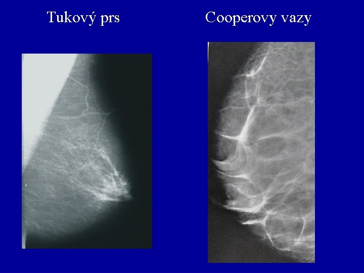 Tukový prs Cooperovy vazy 