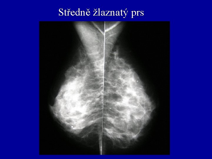 Středně žlaznatý prs 