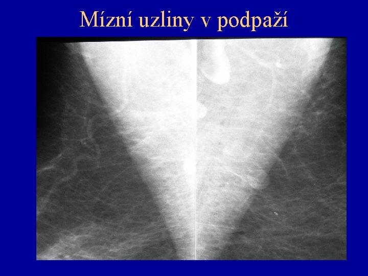 Mízní uzliny v podpaží 