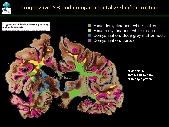 Progressive MS and compartmentalized inflammation Brain section immunostained for proteolipid protein Progressive MS and compartmentalized inflammation Brain section immunostained for proteolipid protein