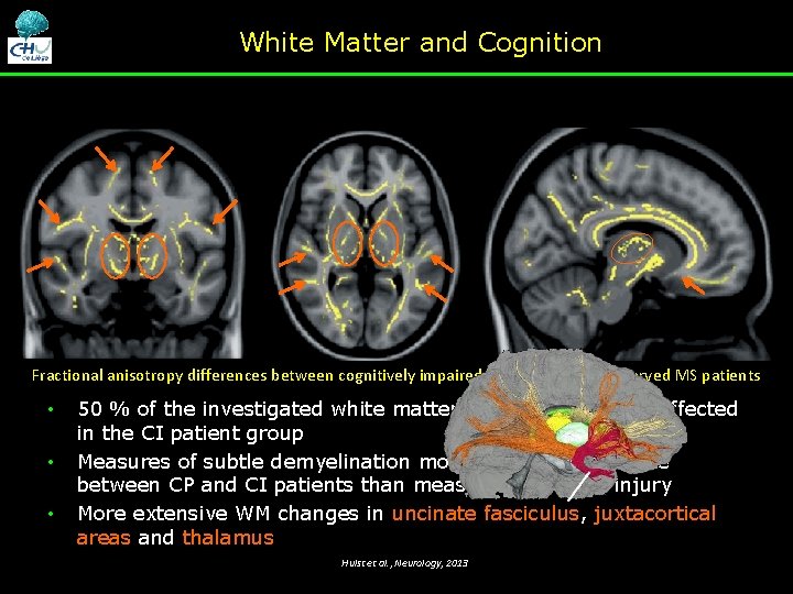 White Matter and Cognition Fractional anisotropy differences between cognitively impaired and cognitively preserved MS White Matter and Cognition Fractional anisotropy differences between cognitively impaired and cognitively preserved MS