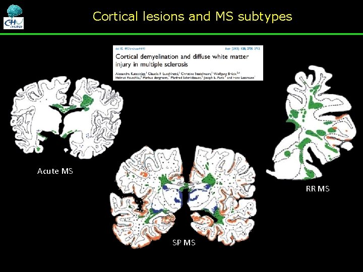 Cortical lesions and MS subtypes Acute MS RR MS SP MS Cortical lesions and MS subtypes Acute MS RR MS SP MS