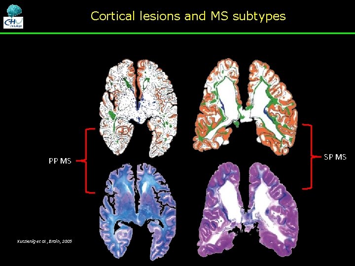 Cortical lesions and MS subtypes PP MS Kutzlenig et al. , Brain, 2005 SP Cortical lesions and MS subtypes PP MS Kutzlenig et al. , Brain, 2005 SP