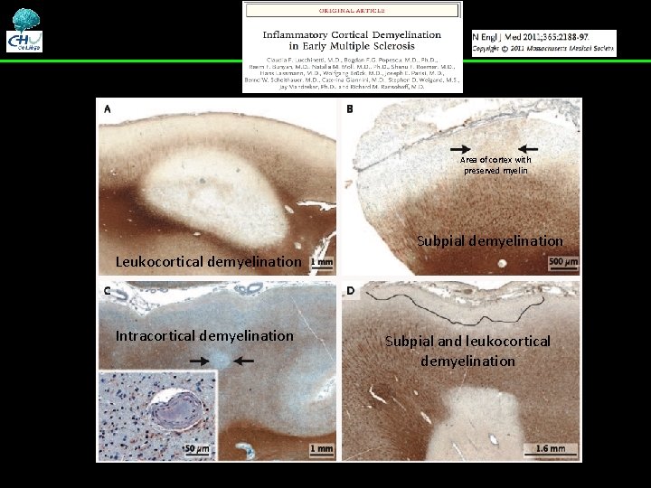 Area of cortex with preserved myelin Subpial demyelination Leukocortical demyelination Intracortical demyelination Subpial and Area of cortex with preserved myelin Subpial demyelination Leukocortical demyelination Intracortical demyelination Subpial and