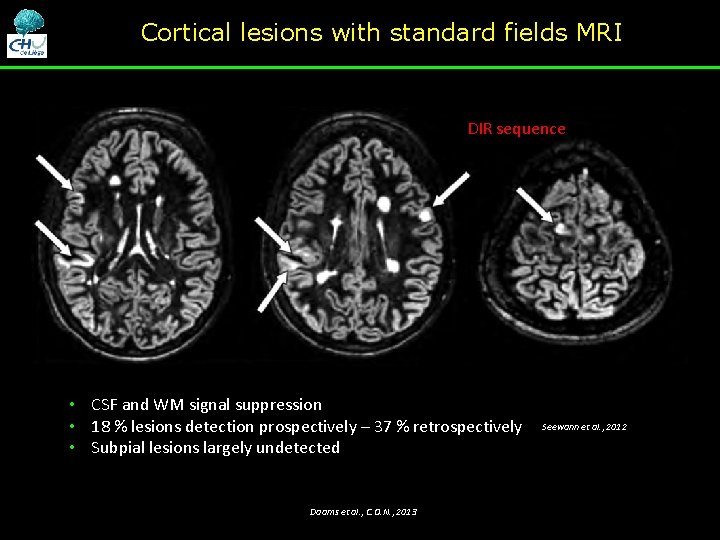 Cortical lesions with standard fields MRI DIR sequence • CSF and WM signal suppression Cortical lesions with standard fields MRI DIR sequence • CSF and WM signal suppression