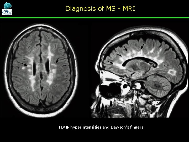 Diagnosis of MS - MRI FLAIR hyperintensities and Dawson’s fingers Diagnosis of MS - MRI FLAIR hyperintensities and Dawson’s fingers