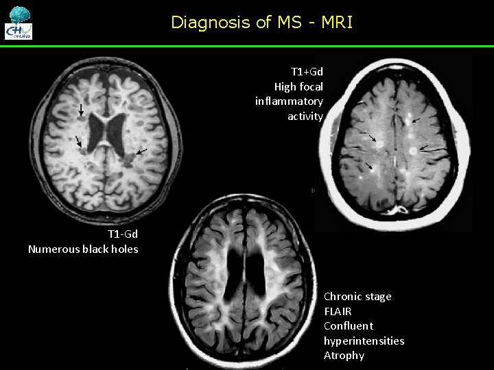 Diagnosis of MS - MRI T 1+Gd High focal inflammatory activity T 1 -Gd Diagnosis of MS - MRI T 1+Gd High focal inflammatory activity T 1 -Gd