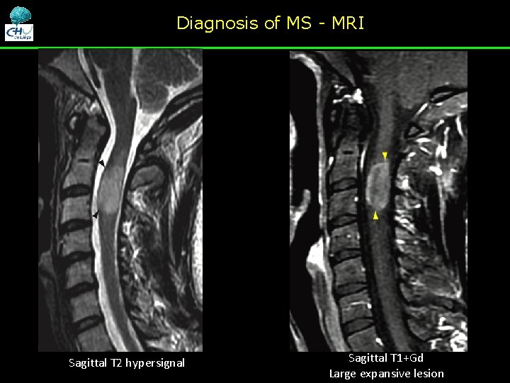 Diagnosis of MS - MRI Sagittal T 2 hypersignal Sagittal T 1+Gd Large expansive Diagnosis of MS - MRI Sagittal T 2 hypersignal Sagittal T 1+Gd Large expansive