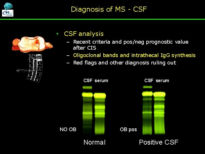 Diagnosis of MS - CSF • CSF analysis – Recent criteria and pos/neg prognostic Diagnosis of MS - CSF • CSF analysis – Recent criteria and pos/neg prognostic