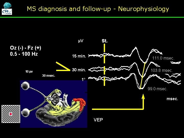 MS diagnosis and follow-up - Neurophysiology µV Oz (-) - Fz (+) 0. 5 MS diagnosis and follow-up - Neurophysiology µV Oz (-) - Fz (+) 0. 5
