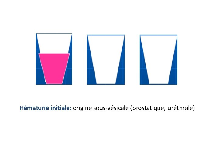Hématurie initiale: origine sous-vésicale (prostatique, uréthrale) 