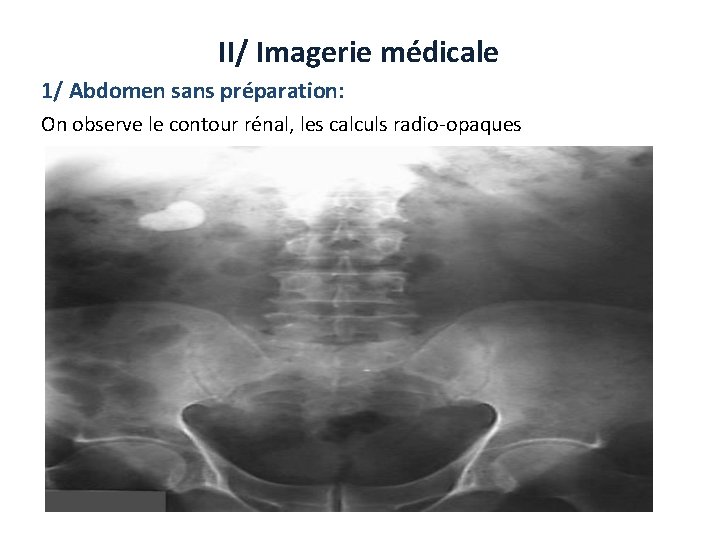 II/ Imagerie médicale 1/ Abdomen sans préparation: On observe le contour rénal, les calculs